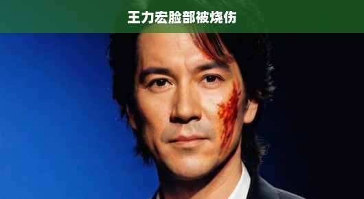 王力宏脸部被烧伤事件揭秘